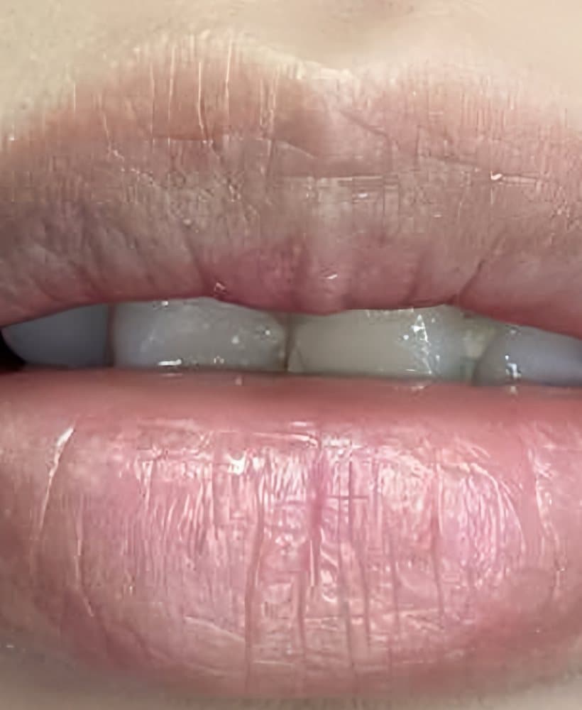 Khử thâm môi – trước khi làm